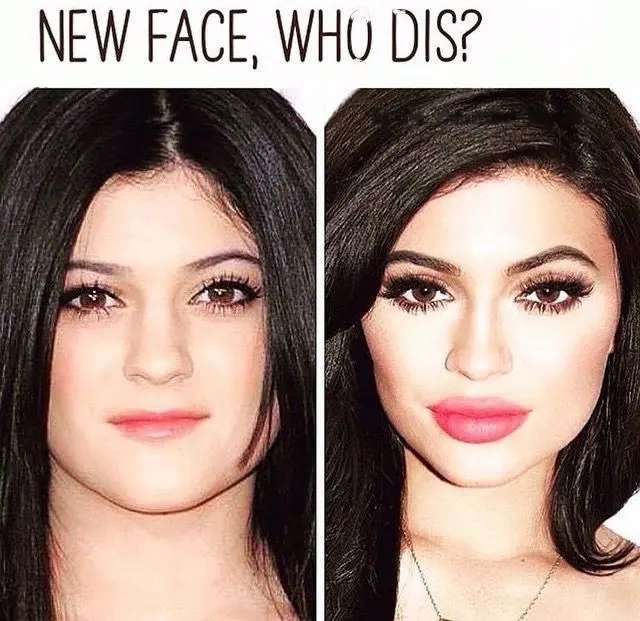 Mein erstes Mal – Die Lippenunterspritzung: Alles, was du wissen musst