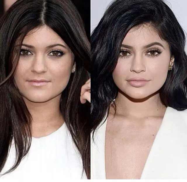 Hey du! Lippenunterspritzungen – auch bekannt als Lip Fillers – sind gerade mega angesagt, vor allem seit Kylie Jenner das Thema so richtig ins Rampenlicht gerückt hat. Perfekte Lippen sind auf Social Media überall zu sehen. Aber wie schafft man natürliche Ergebnisse? Wir haben die Antworten für dich.