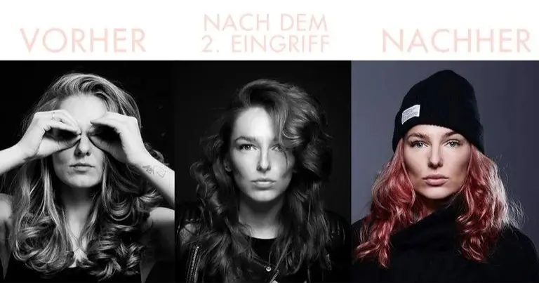 „Ich bin wirklich glücklich mit dem Ergebnis, denn es fällt so gut wie kaum auf. Dadurch, dass ich meine Lippen schrittweise aufpolstern liess und sich das ältere Hyaluron langsam abbaut, gleicht sich der Effekt aus und die Menschen in meiner Umgebung nehmen es kaum wahr – ausser natürlich, die, die mich schon jahrelang kennen. Mir war für ein volles aber trotzdem natürliches Ergebnis vor allem wichtig, mich an meine natürliche Lippenform zu halten. Denn sonst kann es schnell künstlich wirken. Was ich besonders toll finde, ist, dass ich endlich auch Lippenstift tragen kann. Mein Freund ist übrigens auch begeistert! Aber jetzt reicht es auch erst mal mit den Schönheitseingriffen.“